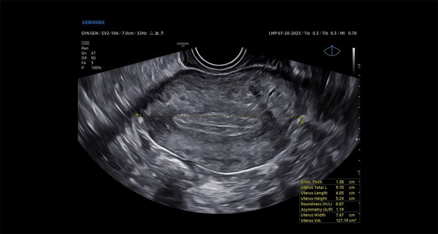 usa-samsung-wh-v7-uterine-assist
