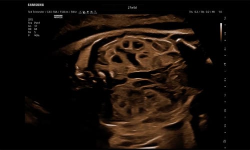 2D Fetal Kidneys
