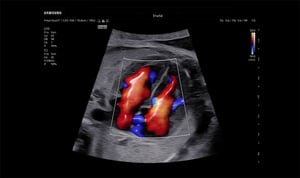 Fetal Heart with LumiFlow