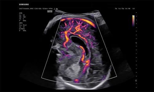 Fetal Brain with MV Flow