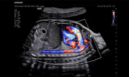 Sagittal Fetal Heart with S-Flow