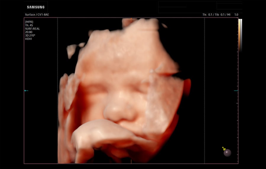 wh-q10-3D-Fetal-Face