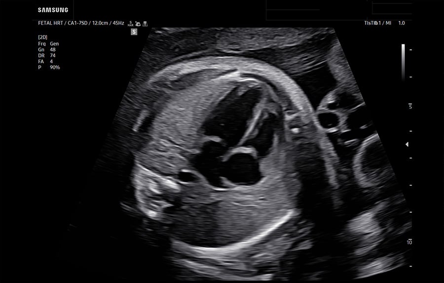 wh-q10-4-Chamber-Fetal-Heart