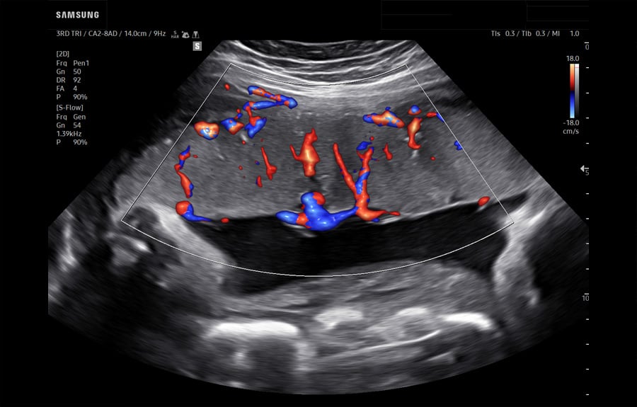 wh-q10-s-flow-placenta