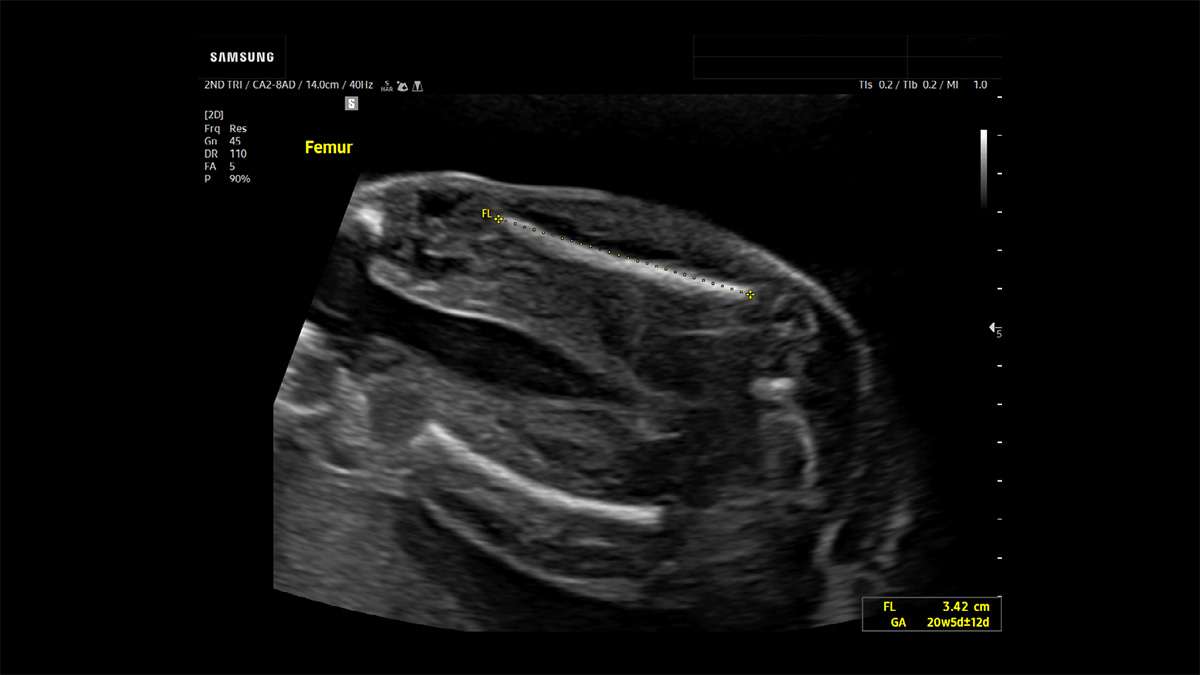 wh-v4-automation-carousel-BiometryAssist-femur