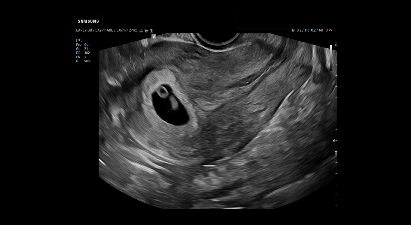 wh-v4-image-features-1st-trimester