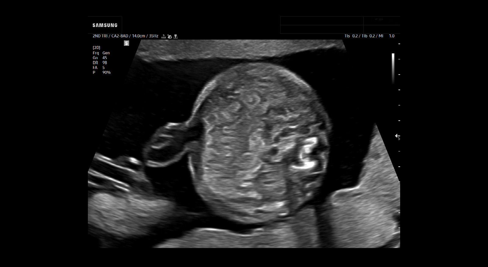 wh-v4-image-features-cord-insertion