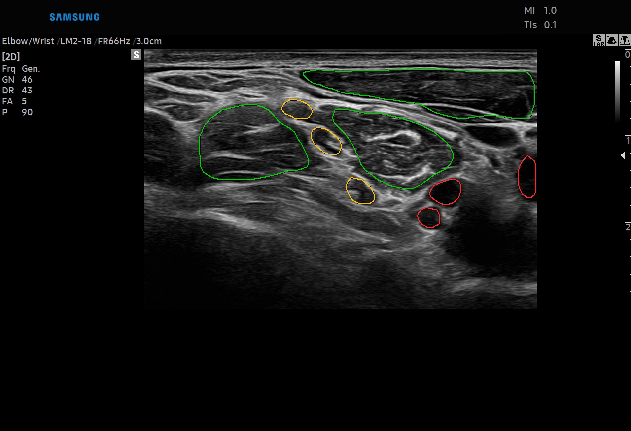 RS85 Prestige Nerve Segmentation